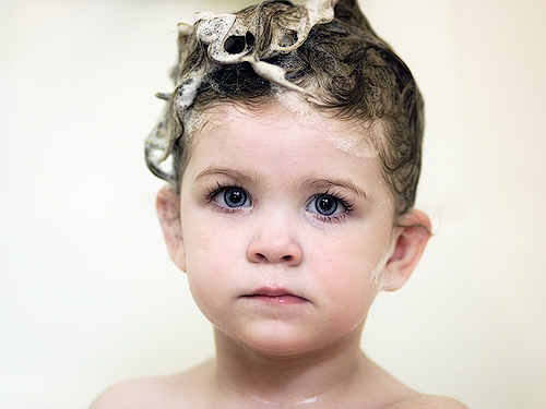 Signs and Symptoms of Dandruff in Kids