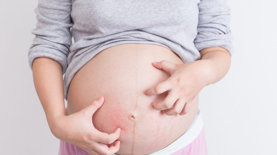 Using Calamine Lotion During Pregnancy: Is It Safe?